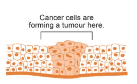 tumour